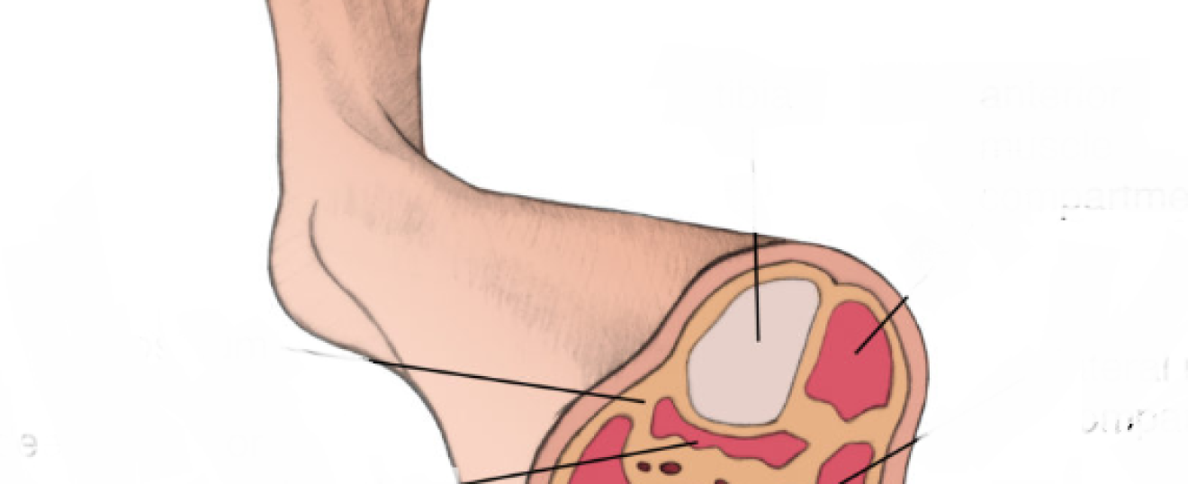 Chronic Exertional Compartments Syndrome