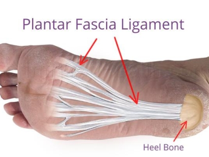 Plantar Fasciitis