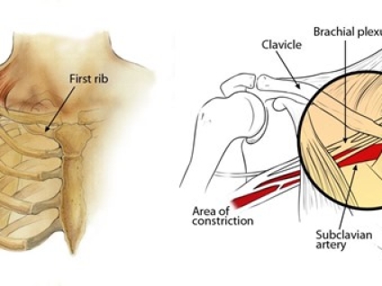 Thoracic Outlet Syndrome