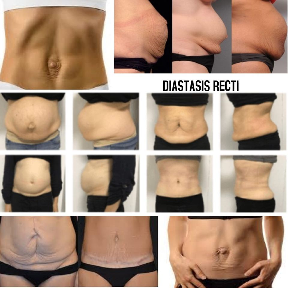 Diastasis Recti: When Ab Muscles Separate in Pregnancy