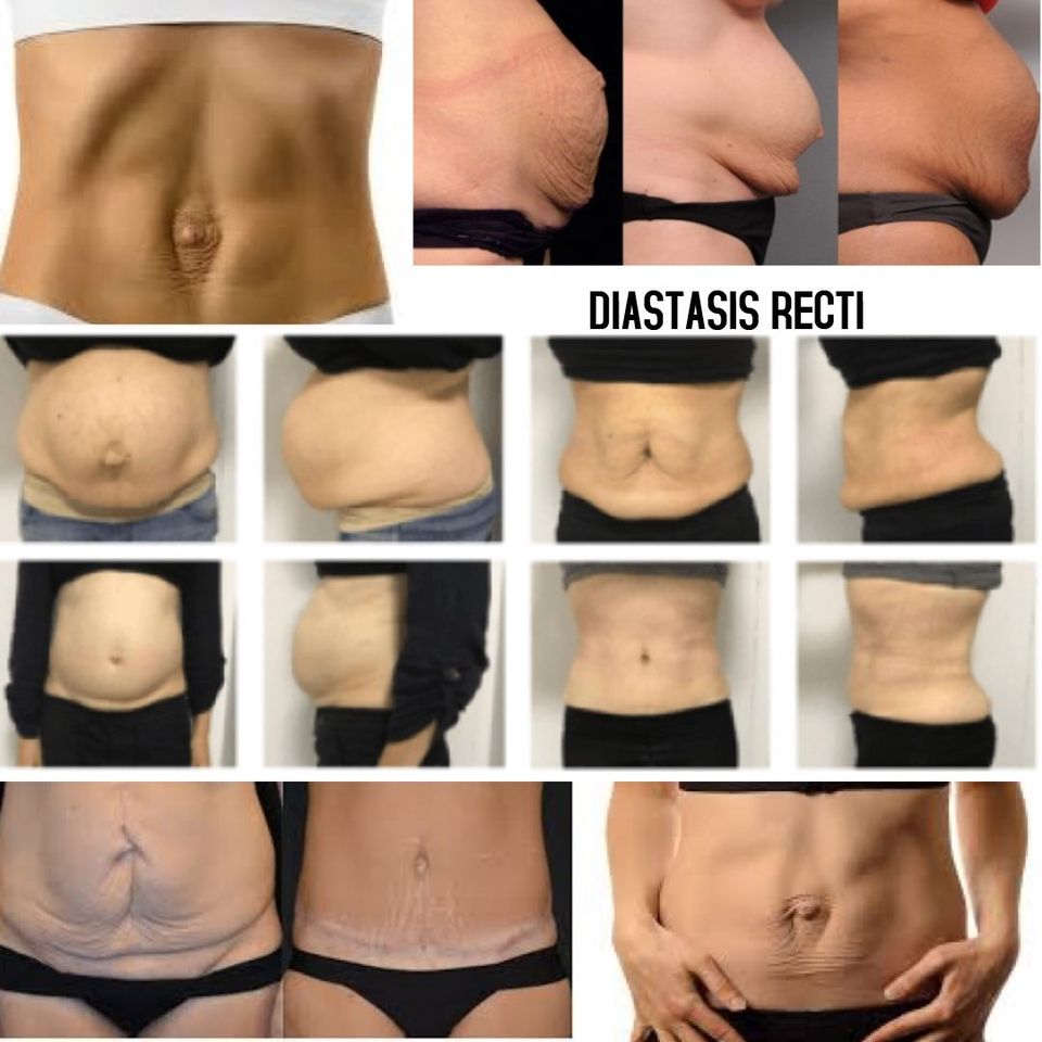 Corset Abdominal flat tummy tightening. Diastisis Recti - post