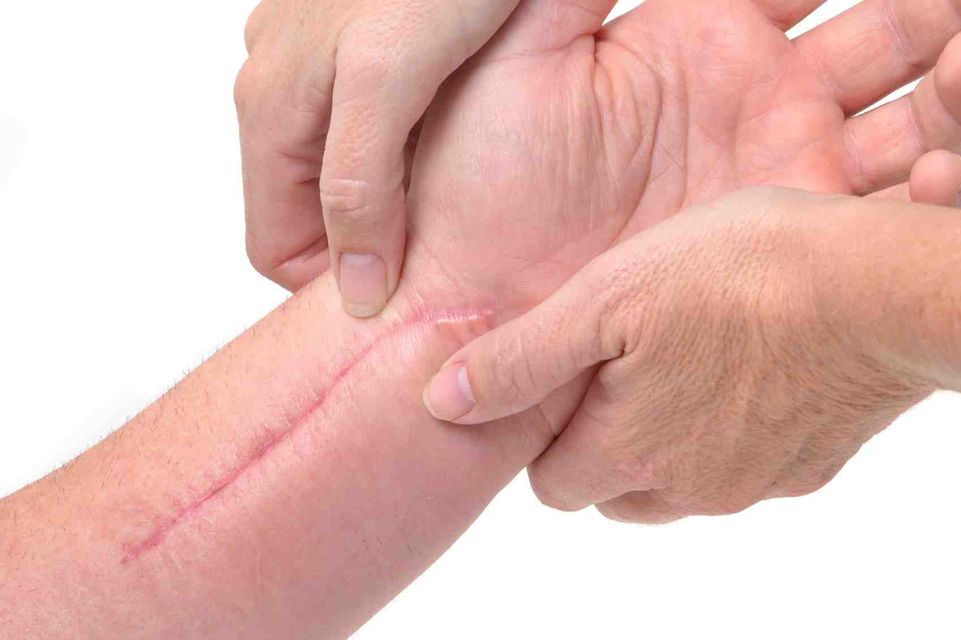 How Massage Can Be Used On Scar Tissue