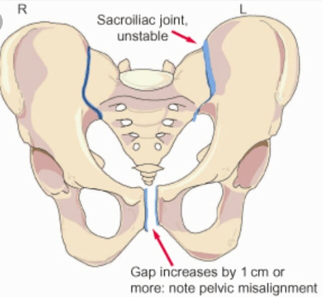 Massage for Symphysis Pubis Dysfunction